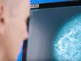 الذكاء الاصطناعي يكتشف مخاطر أمراض القلب الخفية أثناء تصوير الثدي بالأشعة